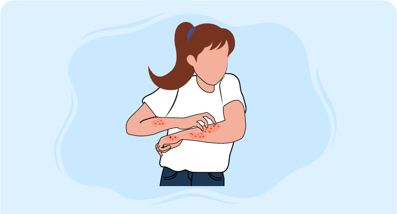 a girl scratching her hands highlighting allergy emergencies training
