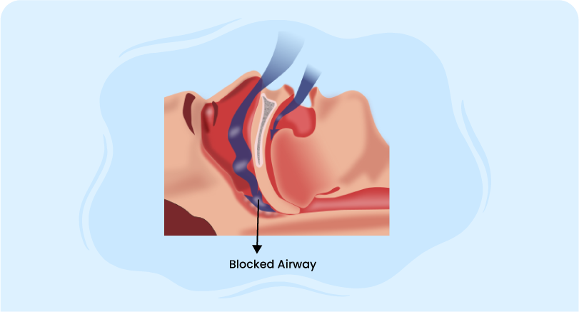 Central Sleep Apnea Syndromes management with blocked airway