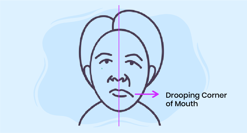 dropping corner of mouth symbolizing bell's palsy