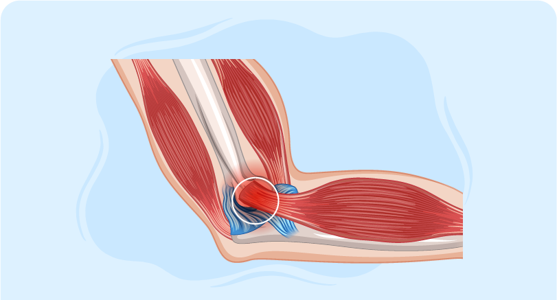 Managing Muscle Spasm