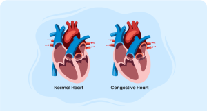 images of normal heart and congestive heart highlighting strategies for Congestive heart failure