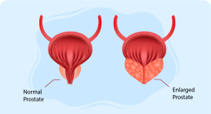 normal and enlarged prostate highlighting managing prostatitis treatment options