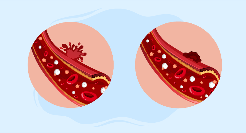 Hemostasis essentials for healthcare professionals