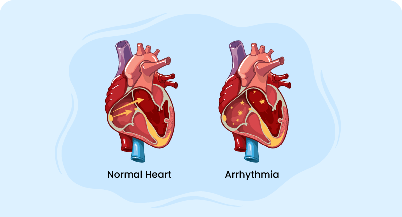 one normal heart and one Arrhythmia heart
