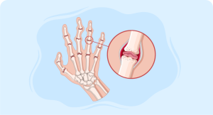illustrating bones of hands and close-up image of finger joint indicating rheumatoid arthritis