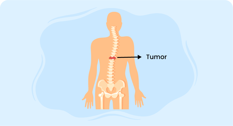 Spinal Tumors metastases