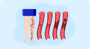 illustration of leg with veins visible indicating venous thrombosis