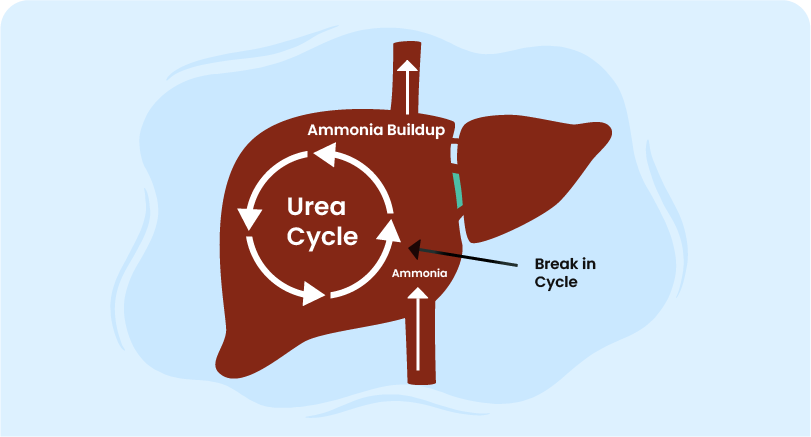 How to manage urea cycle disorders