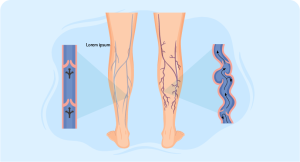 Varicose vein treatment