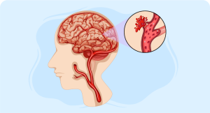 online course on Hemorrhagic Stroke