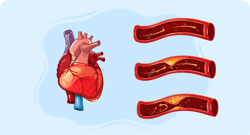 Hyperlipidemia management