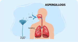 Aspergillosis management course