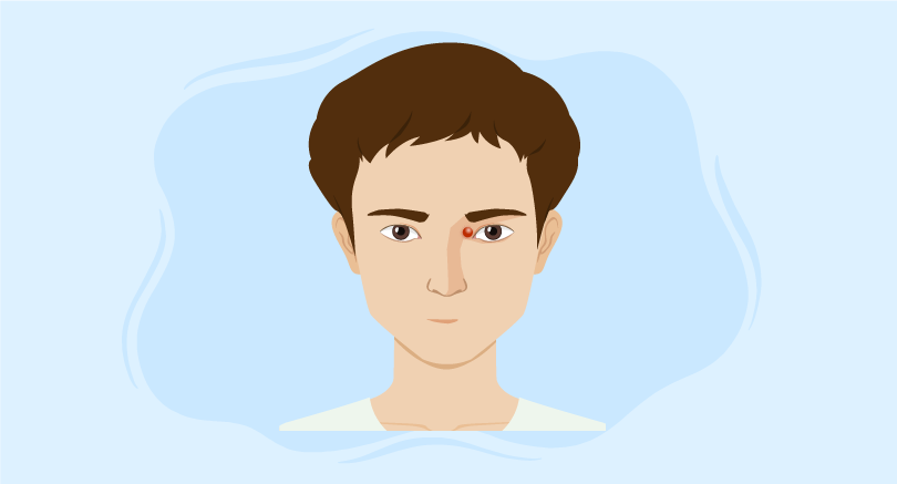 juvenile xanthogranuloma treatment course