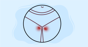 Illustration of the pelvic area with red inflamed spots indicating Lymphogranuloma Venereum