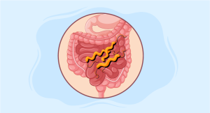 Effective Treatment Strategies for Managing Diphyllobothriasis